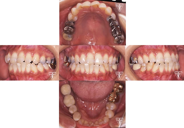 30代 女性 顎のずれによる顎関節症（かみ合わせ治療）：初診時の正面観・側方観・かみ合わせの面の状態