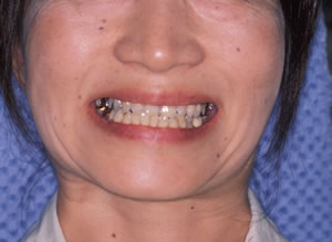 30代 女性 顎のずれによる顎関節症（かみ合わせ治療）：治療前の写真