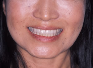 30代 女性 顎のずれによる顎関節症（かみ合わせ治療）：治療後の写真