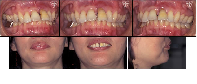 ⑬50代 女性：歯周疾患による上顎前突症（出っ歯）の症例（出っ歯　写真）