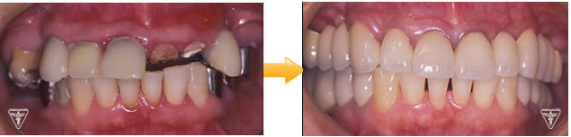 症例：⑭30代 男性：初診から20年、歯ぎしりによる咬耗を改善した症例の現在