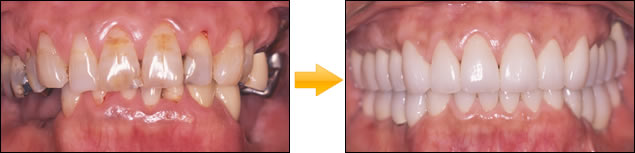 サイナスフロアエレベーション下顎・奥歯・両側欠損をインプラント　写真