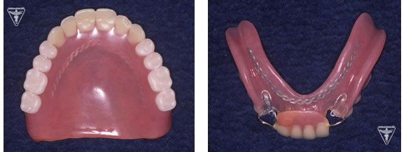 60代 女性 総入れ歯（総義歯）治療前の写真