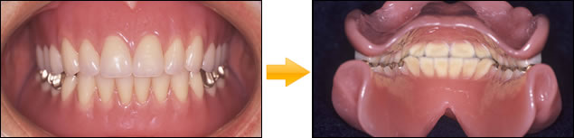 症例：⑨総義歯・総入れ歯 (印象・模型・排列・歯肉形成はすべてドクターの手により調整)