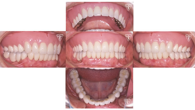70代 女性:最終義歯治療用義歯（入れ歯）