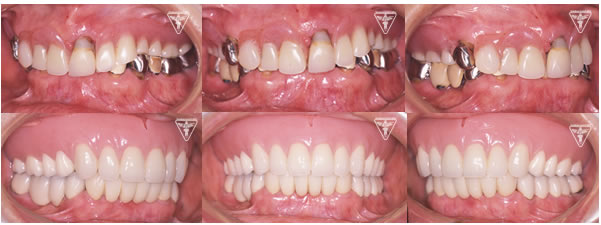 70代 女性:最終義歯治療用義歯（入れ歯）