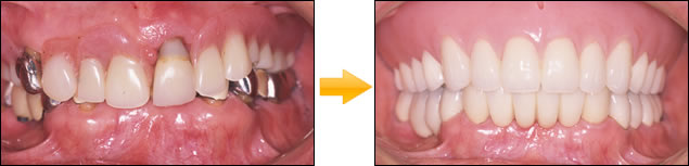 症例：⑨総義歯・総入れ歯 (印象・模型・排列・歯肉形成はすべてドクターの手により調整)