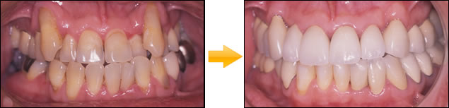 症例：⑨総義歯・総入れ歯 (印象・模型・排列・歯肉形成はすべてドクターの手により調整)