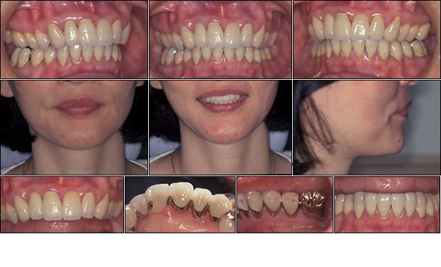 ⑬50代 女性：歯周疾患による上顎前突症（出っ歯）の症例（初診時：出っ歯　写真）