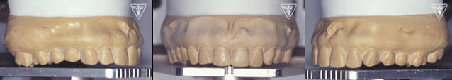 ⑭30代 男性：初診から20年、歯ぎしりによる咬耗を改善した症例（出っ歯　写真）