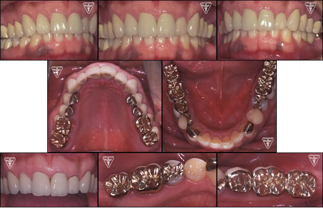 ⑭30代 男性：初診から20年、歯ぎしりによる咬耗を改善した症例（出っ歯　写真）