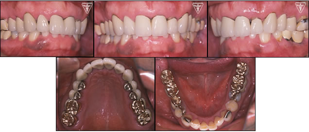 ⑭30代 男性：初診から20年、歯ぎしりによる咬耗を改善した症例