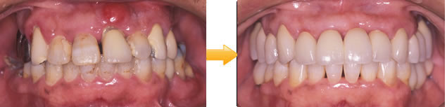 60代男性　重度の歯周疾患と咬合崩壊を伴った症例