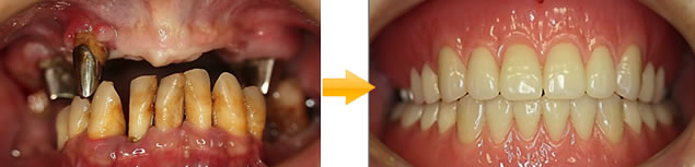 40代 男性 抜歯 即時義歯の症例