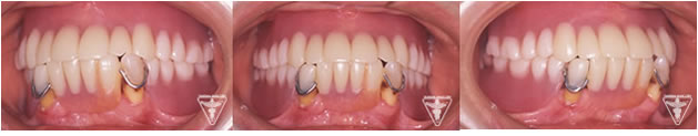 60代 女性 総入れ歯（総義歯）治療前写真