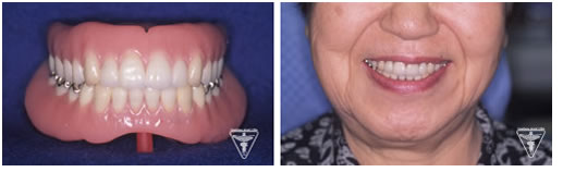 60代 女性 総入れ歯（総義歯）：治療後の顔貌写真
