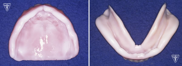 60代 女性 総入れ歯（総義歯）治療中の写真