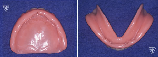 60代 女性 総入れ歯（総義歯）：治療後の写真②