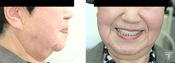 60代 女性 総入れ歯（総義歯）：治療後の顔貌写真