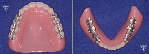 60代 女性 総入れ歯（総義歯）：治療後の写真①