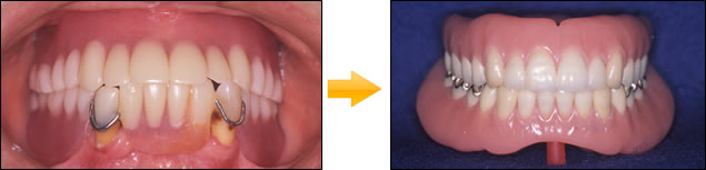 総入れ歯の症例 写真