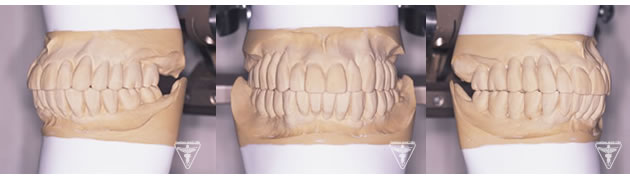 症例：⑤多数歯欠損のインプラント症例(サイナスフロアエレベーション)：治療後の写真