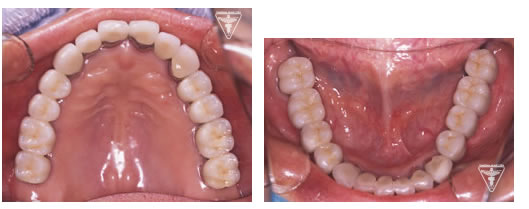 症例：⑤多数歯欠損のインプラント症例：治療後の写真