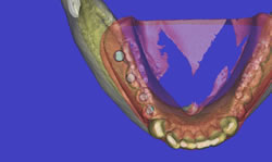 全顎的治療(かみ合わせ治療)：CT診断画像②