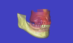 全顎的治療(かみ合わせ治療)：CT診断画像①