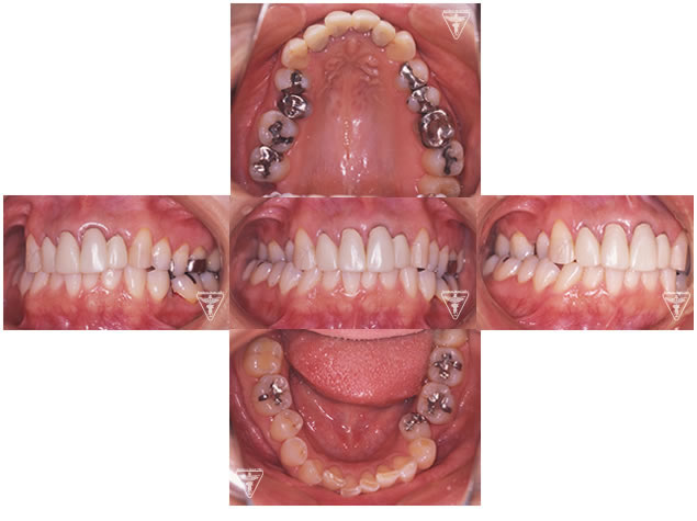 症例 30代女性 歯列を拡大したケース 30代女性 かみ合わせ 矯正治療 上川歯科医院