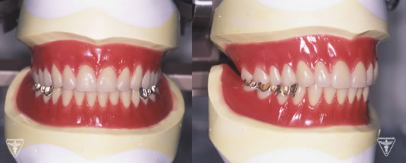 SHILA SYSTEMによりH-Aブレードティースを用いて排列をした最終義歯（入れ歯）