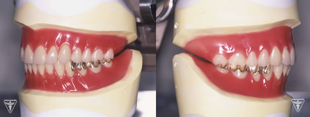SHILA SYSTEMによりH-Aブレードティースを用いて排列をした最終義歯（入れ歯）