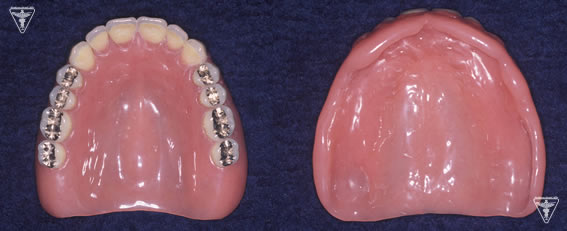 総義歯（総入れ歯）写真