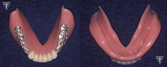 総義歯（総入れ歯）写真
