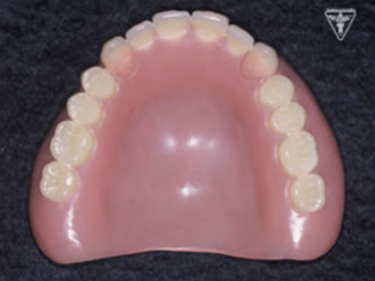 70代女性：入れ歯の痛み、歯のぐらつき、かみ合わせが深いのを改善し再