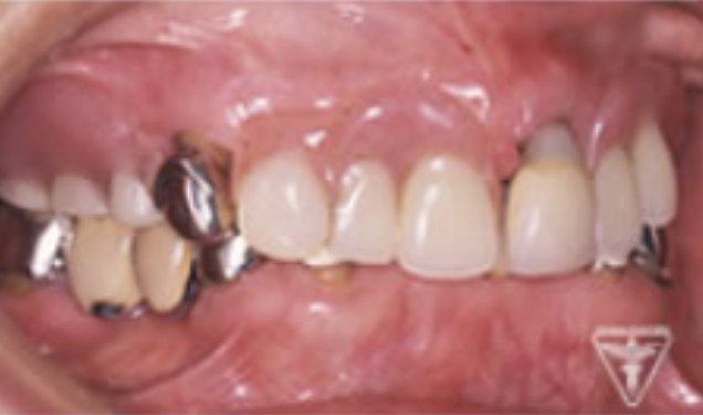 70代女性：入れ歯の痛み、歯のぐらつき、かみ合わせが深いのを改善し再