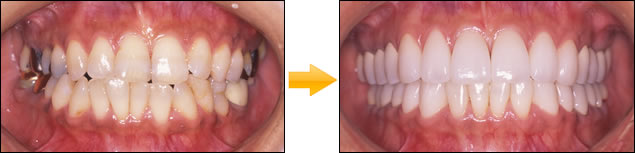 顎のずれによる顎関節症の症例写真