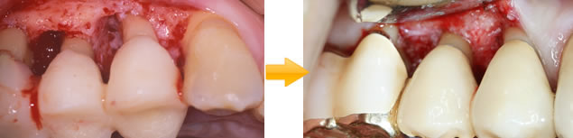 60代 男性：GTR再生療法で歯を抜かずに残した症例