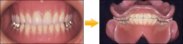 総義歯 (印象・模型・排列・歯肉形成はすべてドクターの手により調整)
